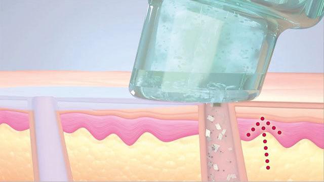 Aquafacial-Hydrafacial behandlung